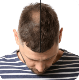 Chute de cheveux